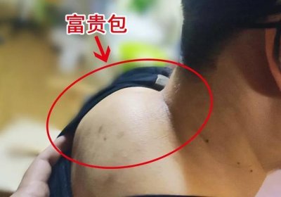 ​脖子后面的“富贵包”=“夺命包”？4个简单抬头动作助你缓解