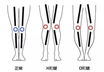 ​孩子怎样的腿才算标准，请父母自检